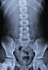 x-ray of the abdominal cavity and pelvis in direct projection, medical research,urography