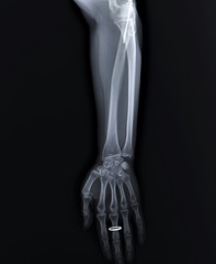 x-ray with a fracture of the ulnar process fixed by spokes