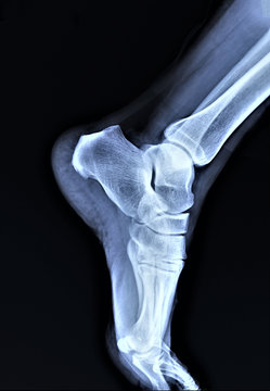 normal radiography of the ankle joint in the lateral projection