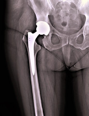 x-ray of hip replacement,implantation, orthopedics