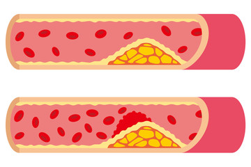 動脈硬化　血管