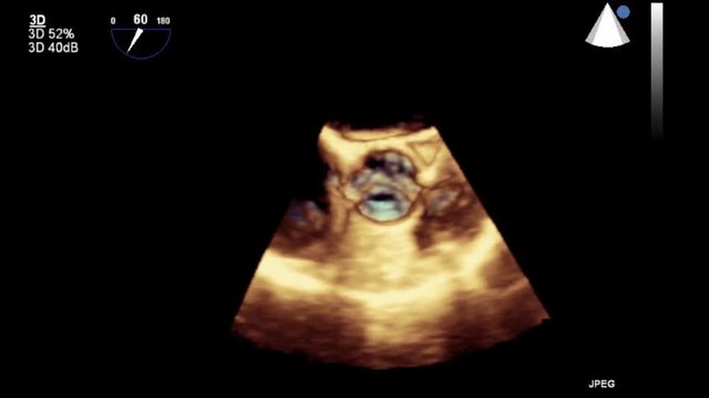 High quality transesophageal ultrasound video in 3D mode.