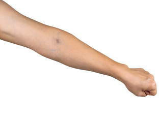 Bruises from blood collection isolated. Purple bruise on the arm.