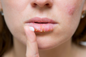 Part of a young woman's face with a virus herpes on lips, treatment with ointment. Young woman with cold sore applying cream onto lips