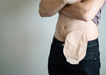 Front view on colostomy bag attached to man patient, medical theme. Skin color ostomy pouch...