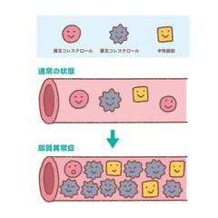 コレステロール　中性脂肪　善玉　悪玉　動脈硬化　イラスト