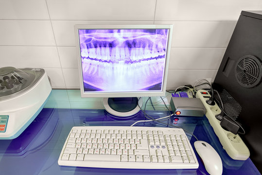 X-ray image of the teeth on a computer monitor