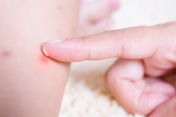 Obraz na płótnie Canvas Kid have insect bites, mother applying antiallergic cream children knee