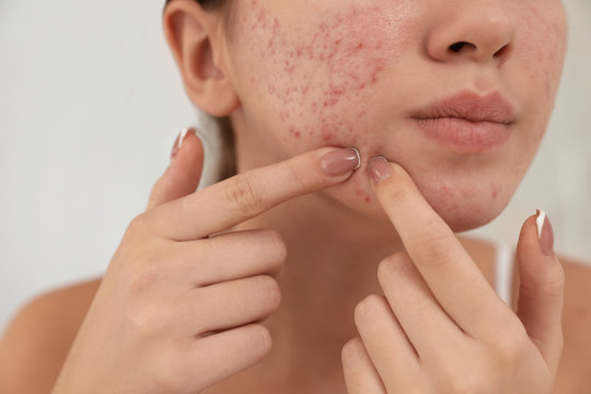 Teen Girl With Acne Problem Squeezing Pimple On Her Face, Closeup