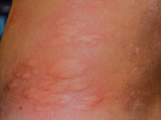 Allergy skin back and sides. Allergic reactions on the skin in the form of swelling and redness