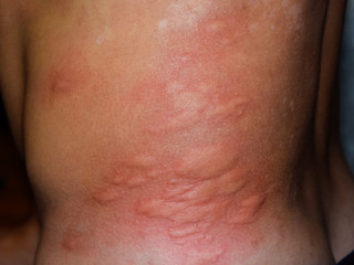 Allergy skin back and sides. Allergic reactions on the skin in the form of swelling and redness