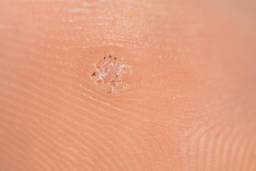 Fototapeta premium Close-up macro of a plantar wart on the bottom of a foot caused by the human papillomavirus, or HPV