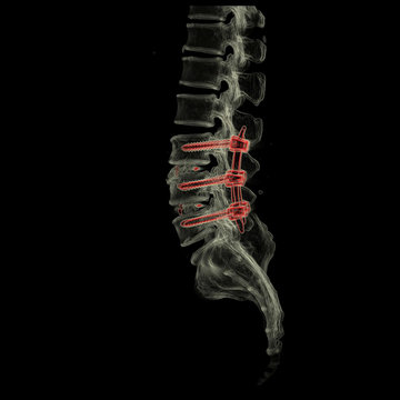3D computed tomography (CT) of L-S spine in lateral view with transparent bone technic.