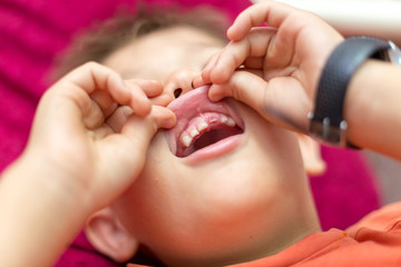 the boy laughs and shows the first tooth. children's teeth, loss and fingers are directed to the incisors, the baby&rsquo;s mouths are close-up, the baby&rsquo;s tooth cutter is absent