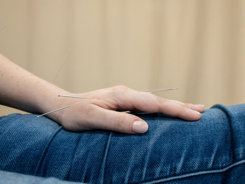 Acupuncture in Hand