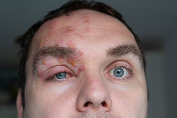 Man with Herpes Zoster (shingles) on the face, close up. Inflamed eyelid and red eye of a man suffering from herpes on the face. Purulent blisters on the face during Shingles