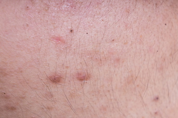 Fototapeta premium Skin healing from pimple blackheads that was squeezed pooped out
