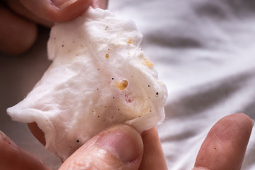 Whiteheads and blackheads pus squeezed from teenager face