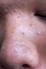 Fototapeta premium Ugly pimples blackheads on nose of teenager