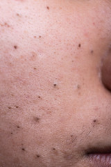 Fototapeta premium Ugly pimples blackheads on cheek face of teenager