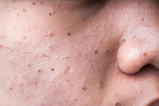 Ugly pimples blackheads on cheek face of teenager