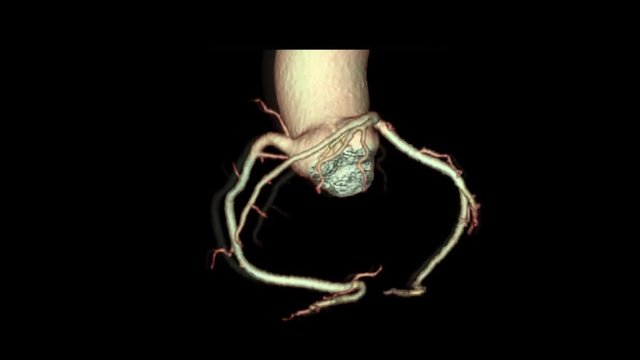 3D SCAN CTA Coronary artery, coronary tree.