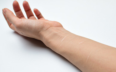 female hand close-up with scars on the veins.