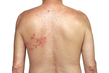 Herpes zoster on the right side of torso on the white background
