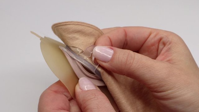 Colostomy bag, supply needed after colostomy surgery - colon cancer treatment. 2 piece ostomy bag in skin color. Medical theme. Stoma bag ready to use. Separating one piece from another