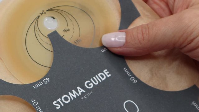 Zoom in colostomy bag, supply needed after colostomy surgery - colon cancer treatment. Ostomy bag in skin color. Medical theme. Choosing the correct size for opening with stoma guide.