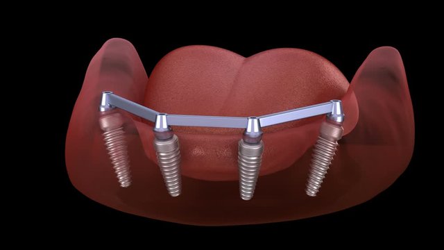 Removable Mandibular prosthesis with gum All on 4 system supported by implants. Medically accurate 3D animation of human teeth and dentures