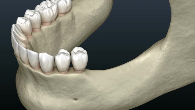 Cleavage of the alveolar ridge, augmentation, implantation. Dental surgery, 3D animation.