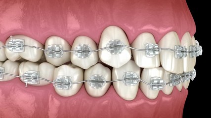 Abnormal teeth position and correction with clear braces tretament. Medically accurate dental 3D animation