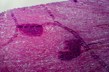Acute pyelonephritis, light micrograph, photo under microscope