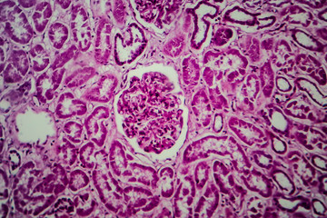 Histopathology of diffuse sclerosing glomerulonephritis, light micrograph, photo under microscope