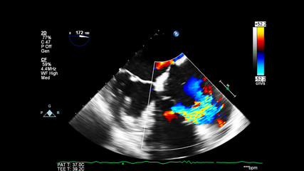 Image of the heart during transesophageal ultrasound with Doppler mode.