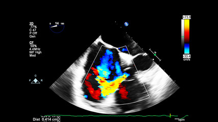 Image of the heart during transesophageal ultrasound with Doppler mode.