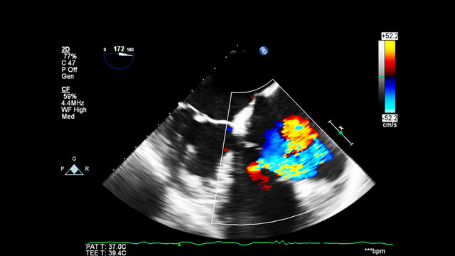Image of the heart during transesophageal ultrasound with Doppler mode.