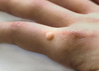Common wart ( Verruca vulgaris ) a flat wart commonly found on the hand  of children and  adults. They are caused by a type of human papillomavirus ( HPV ) - obrazy, fototapety, plakaty