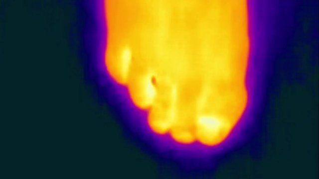 Thermal Medical Imaging Of Toes On Foot Being Wiggled Back And Forth