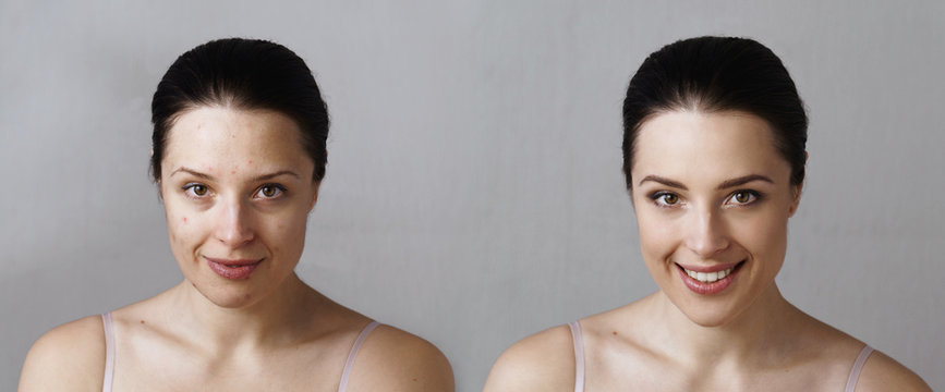Comparison photo of woman with smiling face before and after treatment
