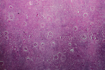 Chronic glomerulonephritis, light micrograph, photo under microscope