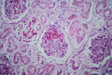 Acute glomerulonephritis, light micrograph, photo under microscope
