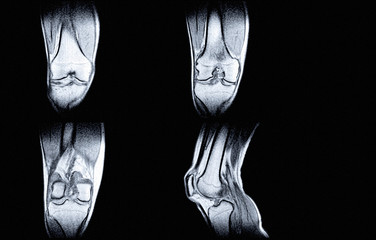 Magnetic resonance imaging (MRI) of right knee. Closed injury of the knee joint, with...