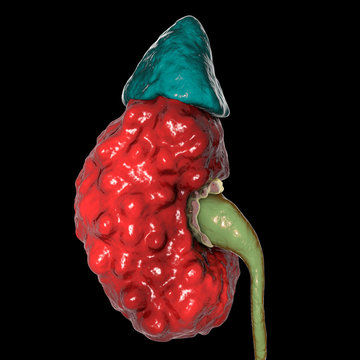 Chronic pyelonephritis, 3D illustration showing irregular scarred cortical surface particularly at poles and dilated ureter