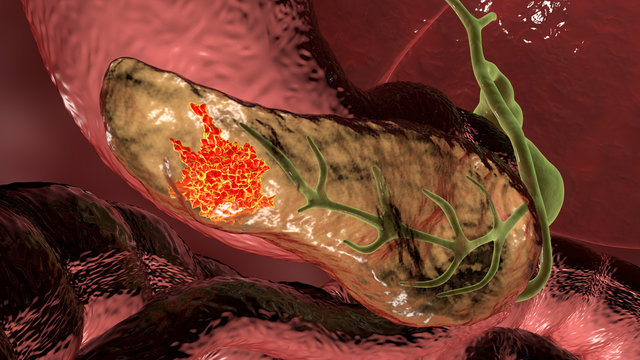Pancreatic cancer, malignant tumor of pancreas, 3D illustration