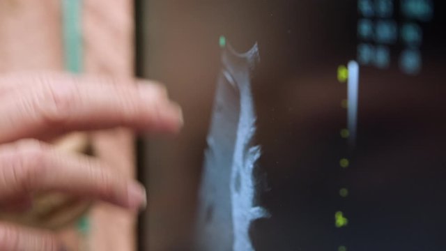 the doctor points to the ultrasound screen with his finger. UHD process 50p