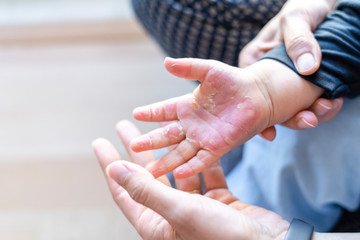 Burned hand of small child