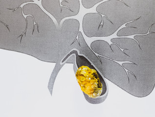 Gall bladder stone, schematic depiction, large sized Gallstone, Result of gallstone disease.