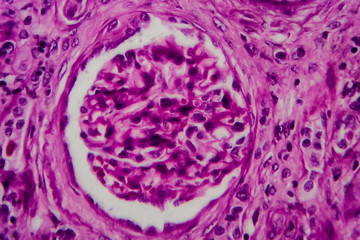 Chronic glomerulonephritis, light micrograph